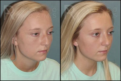 Rhinoplasty <span class=small>By Dr. Daniel Rousso</span> Before & After Gallery - Patient 121502988 - Image 2