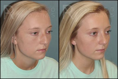 Rhinoplasty Before & After Gallery - Patient 121502988 - Image 2