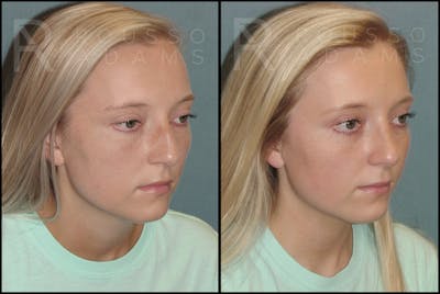 Rhinoplasty Before & After Gallery - Patient 121502988 - Image 1
