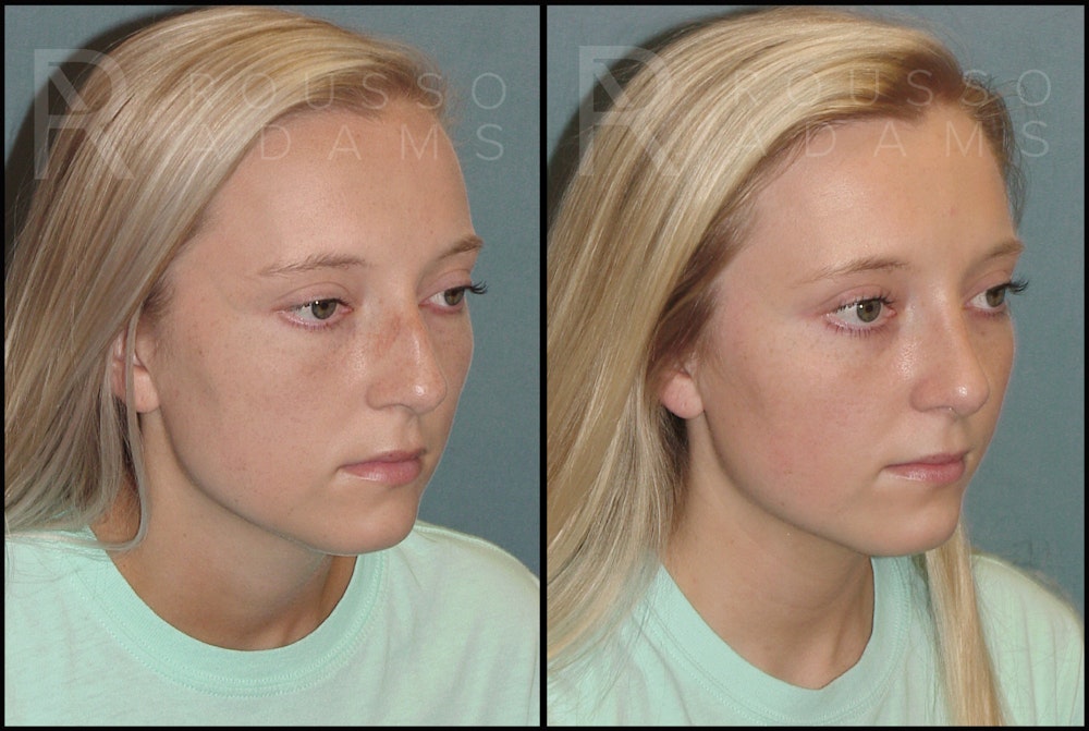 Rhinoplasty <span class=small>By Dr. Daniel Rousso</span> Before & After Gallery - Patient 121502988 - Image 2