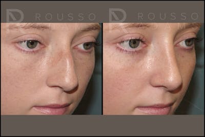 Rhinoplasty <span class=small>By Dr. Daniel Rousso</span> Before & After Gallery - Patient 121502988 - Image 4