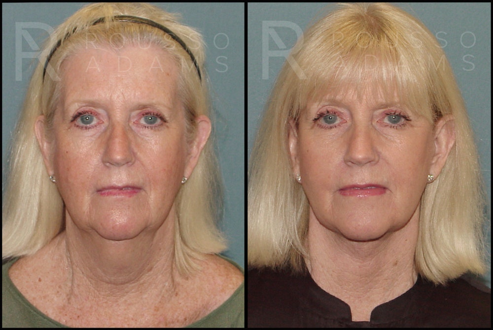 Facelift Before & After Gallery - Patient 121502990 - Image 2