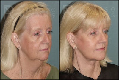 Facelift Before & After Gallery - Patient 121502990 - Image 1