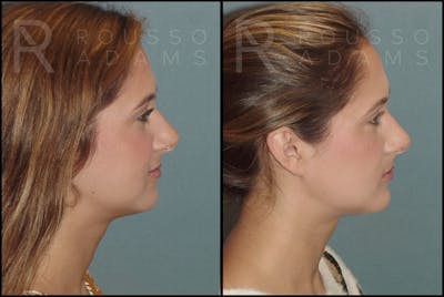 Facial Implants Before & After Gallery - Patient 147124262 - Image 1
