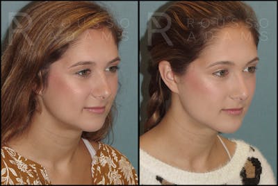 Facial Implants <span class=small>By Dr. Daniel Rousso</span> Before & After Gallery - Patient 121594771 - Image 2