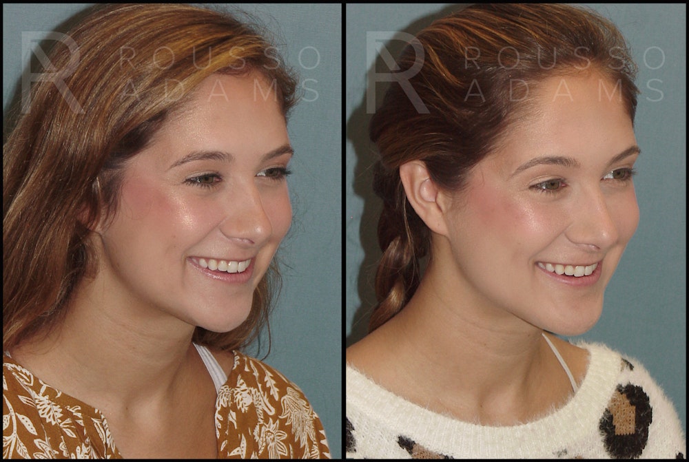 Facial Implants Before & After Gallery - Patient 147124262 - Image 3