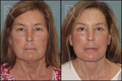 Plasma Skin Resurfacing <span class=small>By Dr. Daniel Rousso</span> Before & After Gallery - Patient 121594828 - Image 1