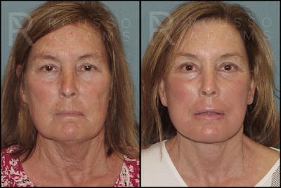 Blepharoplasty Before & After Gallery - Patient 121594818 - Image 1