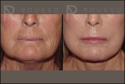 Plasma Skin Resurfacing Before & After Gallery - Patient 147124284 - Image 2