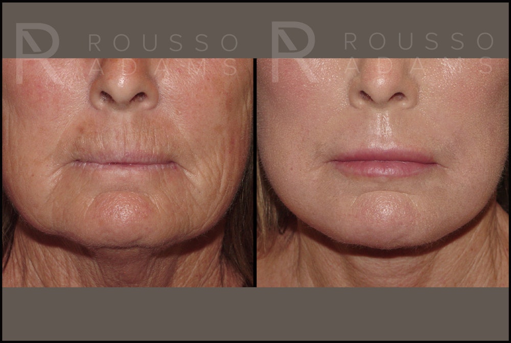 Plasma Skin Resurfacing Before & After Gallery - Patient 121594828 - Image 2