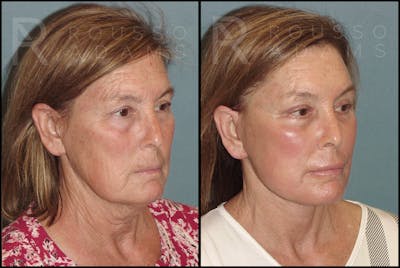 Facelift Before & After Gallery - Patient 121594851 - Image 1
