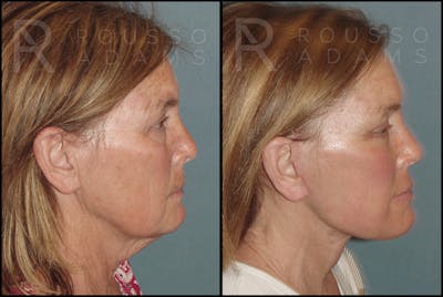 Plasma Skin Resurfacing Before & After Gallery - Patient 121594828 - Image 4