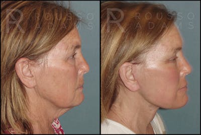 Plasma Skin Resurfacing <span class=small>By Dr. Daniel Rousso</span> Before & After Gallery - Patient 121594828 - Image 4