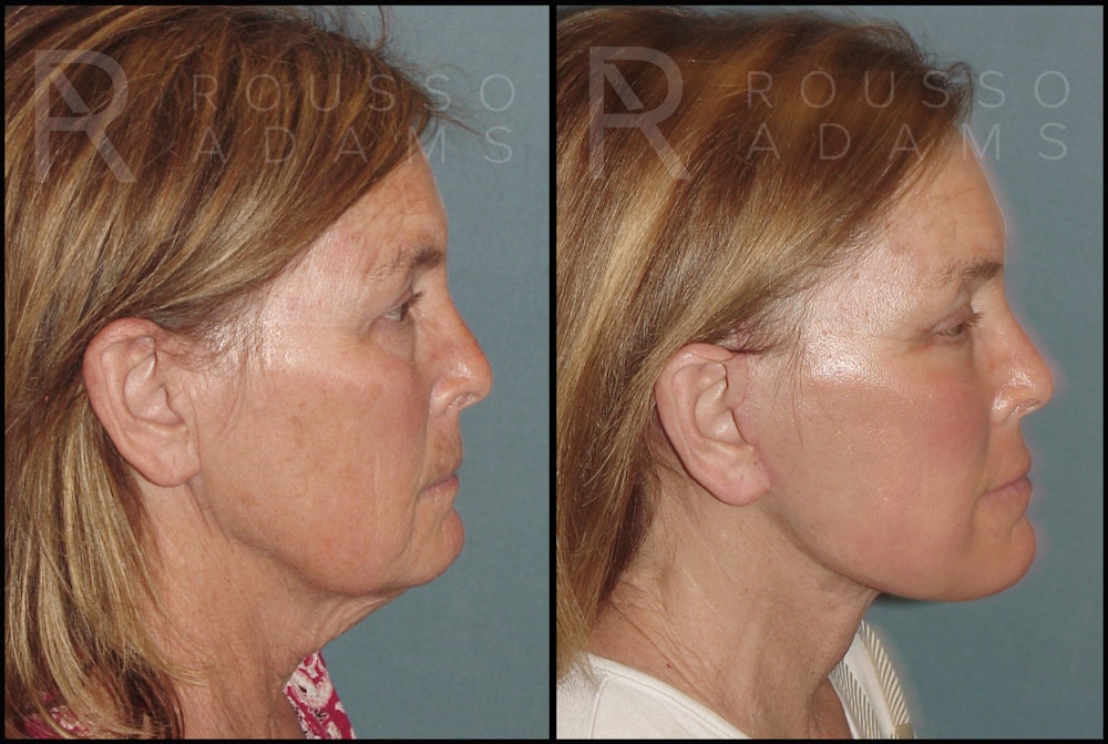 Blepharoplasty Before & After Gallery - Patient 121594818 - Image 4
