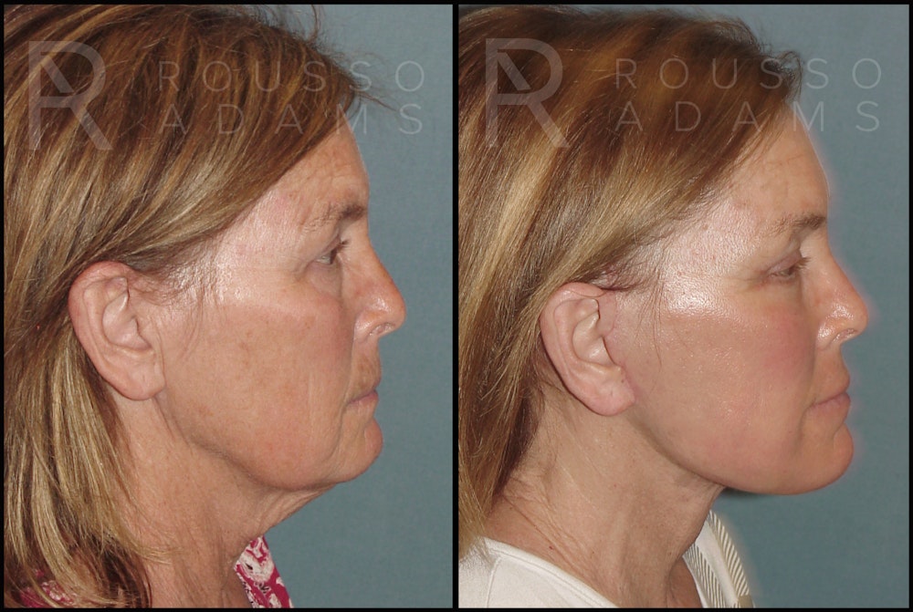 Plasma Skin Resurfacing <span class=small>By Dr. Daniel Rousso</span> Before & After Gallery - Patient 121594828 - Image 4
