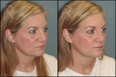 Liquid Rhinoplasty Before & After Gallery - Patient 121959754 - Image 2