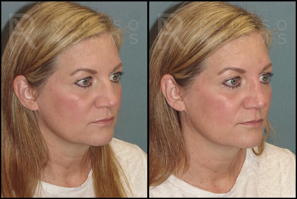 Liquid Rhinoplasty Before & After Gallery - Patient 121959754 - Image 2