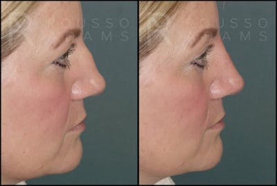 Liquid Rhinoplasty Before & After Gallery - Patient 121959754 - Image 1