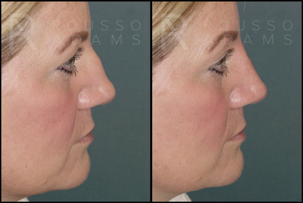 Liquid Rhinoplasty Before & After Gallery - Patient 121959754 - Image 1