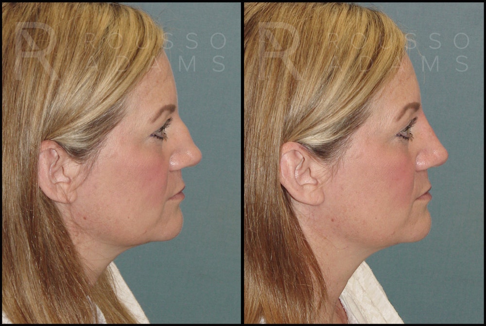 Liquid Rhinoplasty Before & After Gallery - Patient 121959754 - Image 3