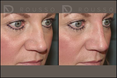 Liquid Rhinoplasty Before & After Gallery - Patient 121959754 - Image 4