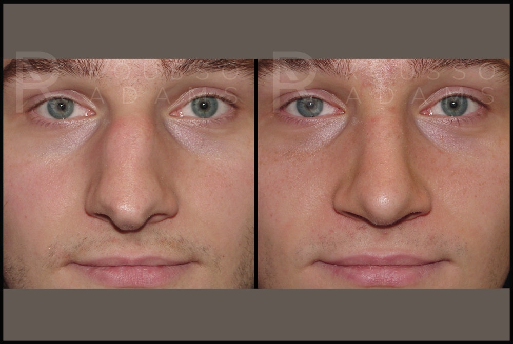 Rhinoplasty Before & After Gallery - Patient 122270075 - Image 4