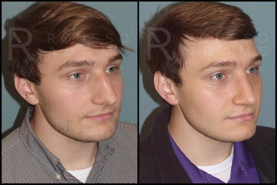 Rhinoplasty Before & After Gallery - Patient 122270075 - Image 1