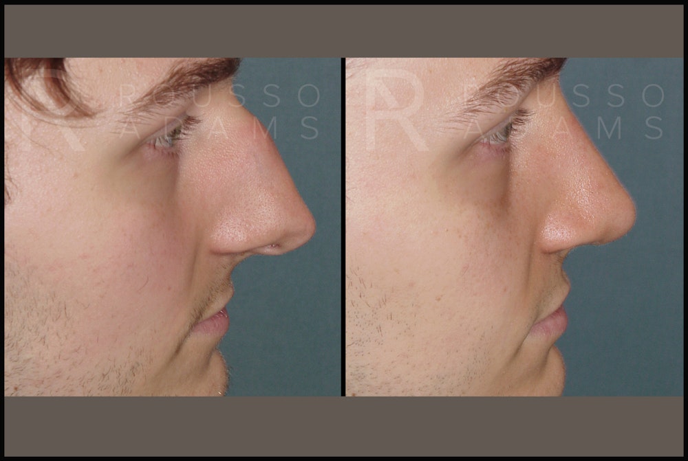 Rhinoplasty Before & After Gallery - Patient 122270075 - Image 3