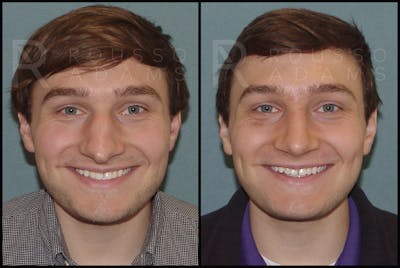 Rhinoplasty Before & After Gallery - Patient 122270075 - Image 2