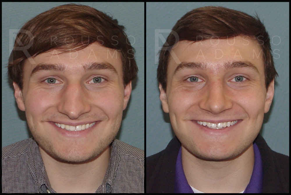 Rhinoplasty Before & After Gallery - Patient 122270075 - Image 2