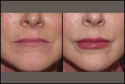 Fillers Gallery Before & After Gallery - Patient 122270511 - Image 1