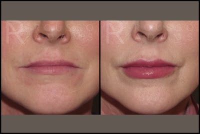 Fillers Before & After Gallery - Patient 122270511 - Image 1