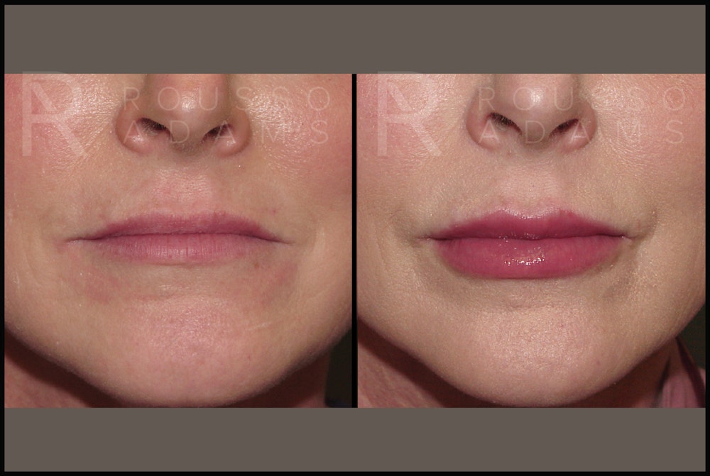 Fillers Gallery Before & After Gallery - Patient 122270511 - Image 1