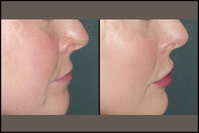 Fillers Gallery Before & After Gallery - Patient 122270511 - Image 2
