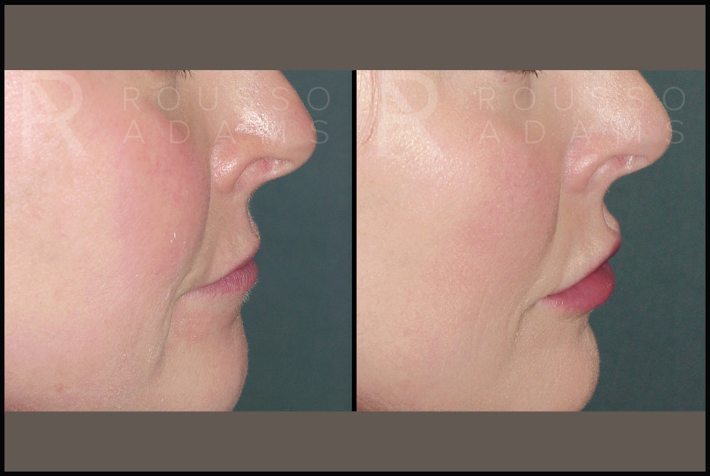 Fillers Before & After Gallery - Patient 122270511 - Image 2