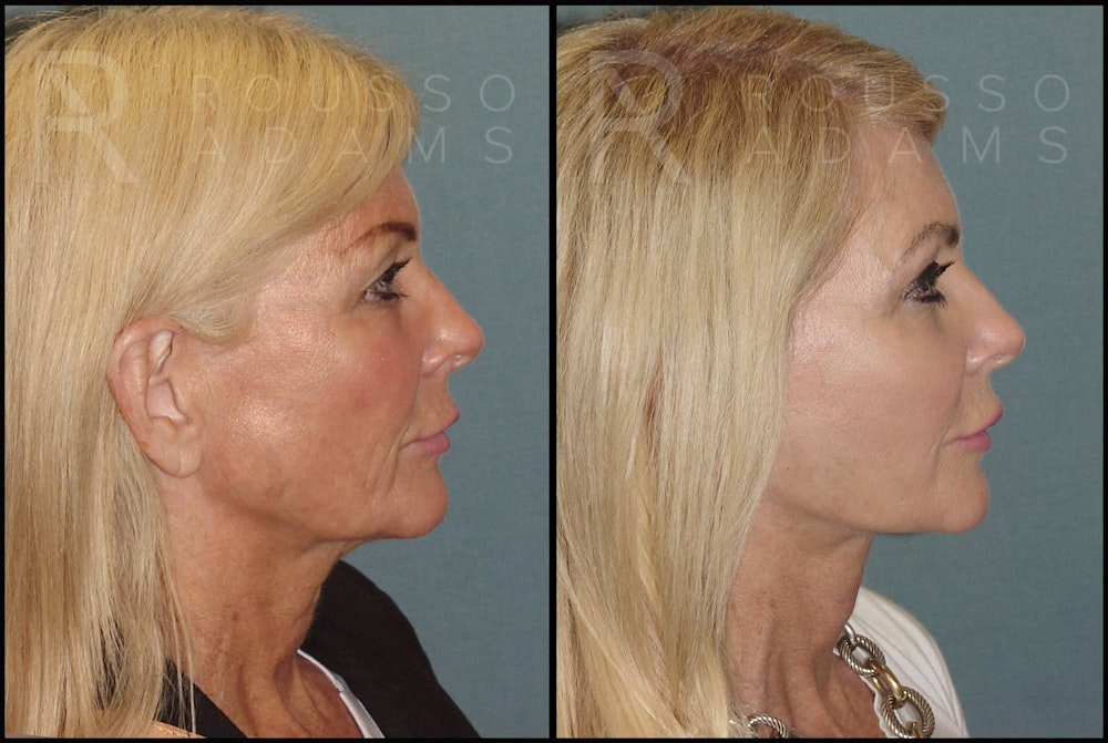 SculptLift™ Before & After Gallery - Patient 122390905 - Image 3