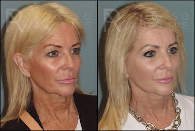 SculptLift™ Before & After Gallery - Patient 122390905 - Image 2