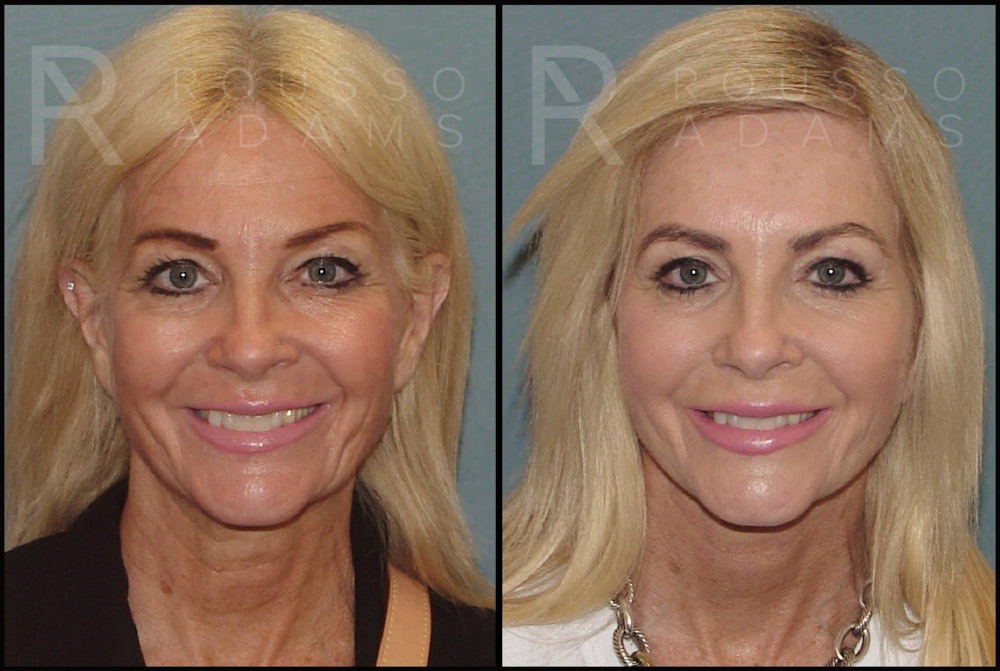 SculptLift™ Before & After Gallery - Patient 122390905 - Image 1
