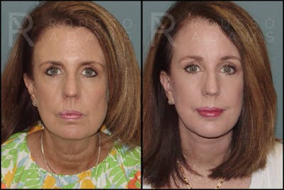 SculptLift™ Before & After Gallery - Patient 141628402 - Image 1
