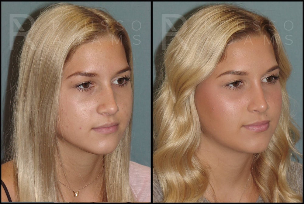 Rhinoplasty Before & After Gallery - Patient 141628422 - Image 1