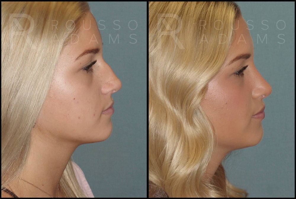 Rhinoplasty Before & After Gallery - Patient 141628422 - Image 2