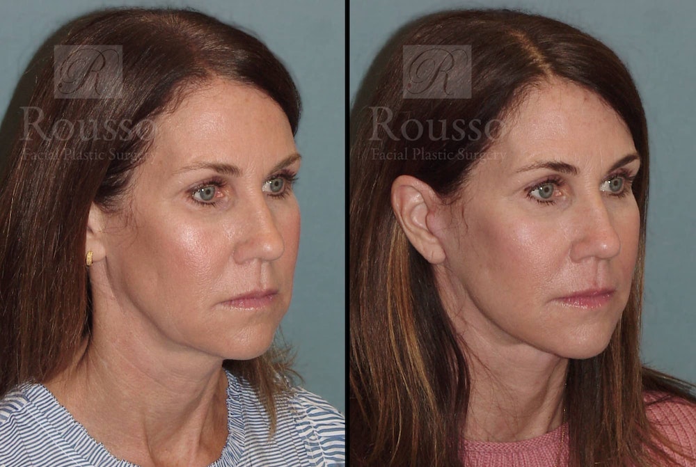 Before & After Image