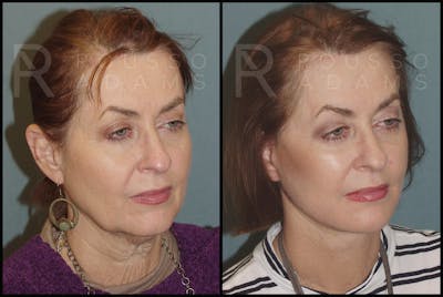 SculptLift™ <span class=small>By Dr. Daniel Rousso</span> Before & After Gallery - Patient 2236647 - Image 1