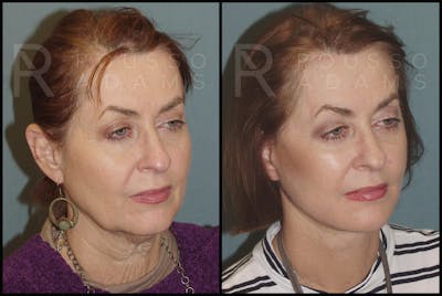 SculptLift™ Before & After Gallery - Patient 2236647 - Image 1
