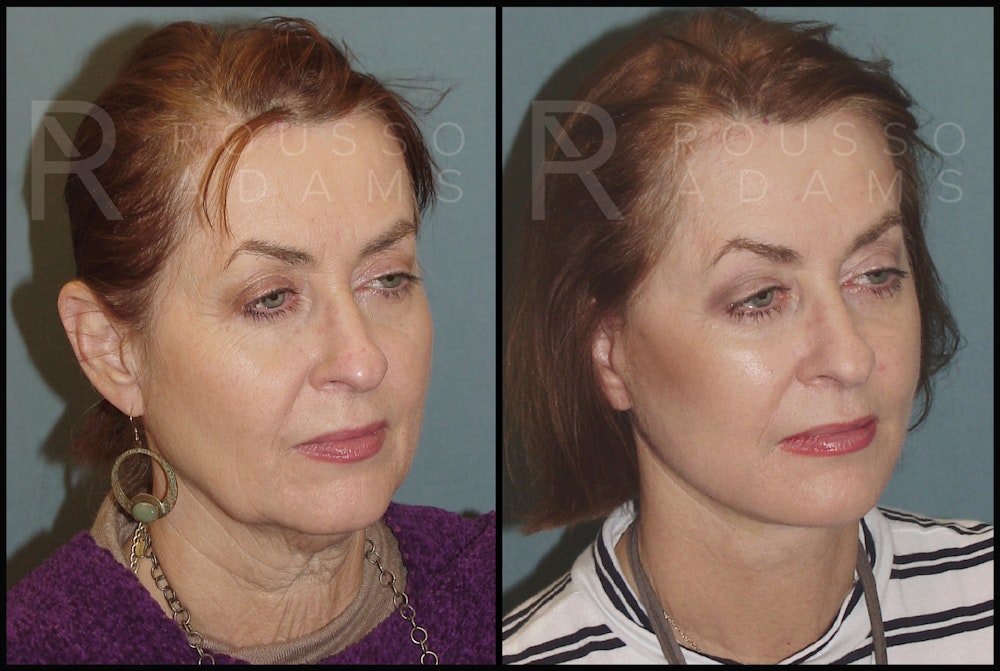 SculptLift™ <span class=small>By Dr. Daniel Rousso</span> Before & After Gallery - Patient 2236647 - Image 1
