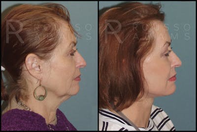 SculptLift™ <span class=small>By Dr. Daniel Rousso</span> Before & After Gallery - Patient 2236647 - Image 2