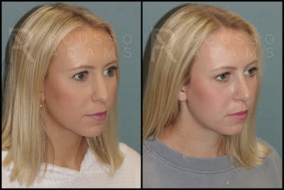 Rhinoplasty Before & After Gallery - Patient 143442177 - Image 1