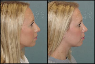 Rhinoplasty Before & After Gallery - Patient 143442177 - Image 2