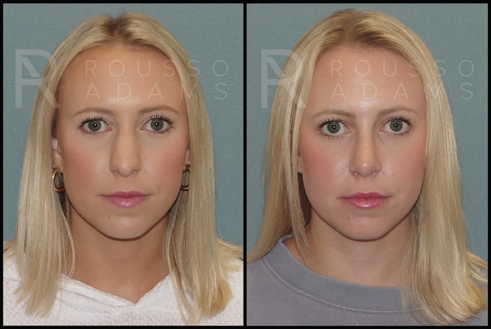 Rhinoplasty Before & After Gallery - Patient 143442177 - Image 3