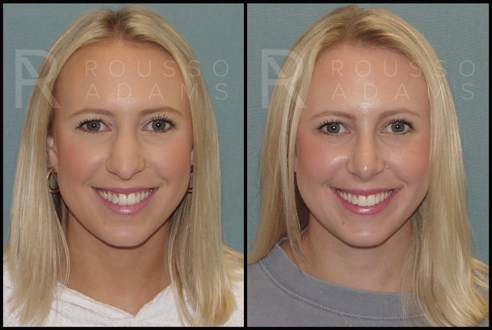 Rhinoplasty Before & After Gallery - Patient 143442177 - Image 4